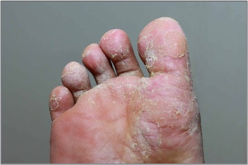 mold infection foot image